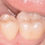 左下奥歯２本の銀歯をセラミックで治療した症例