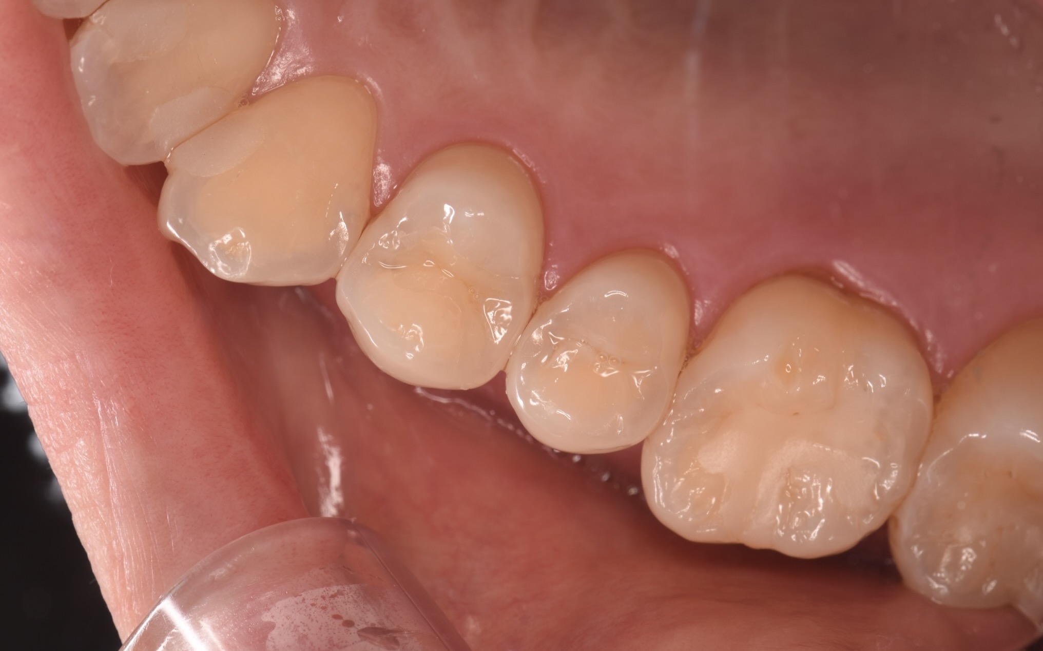 上下奥歯の歯間にできた虫歯をセラミックで治療した症例
