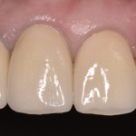 上の前歯の審美不良をオールセラミッククラウンで改善した症例