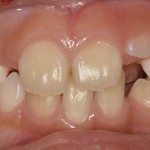 小児期から矯正する事により歯列不正を早期に改善した症例