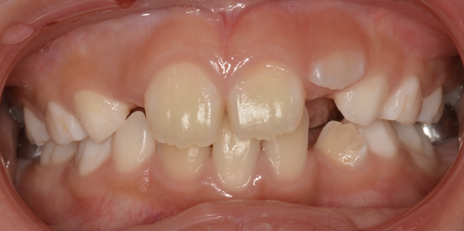 小児期から矯正する事により歯列不正を早期に改善した症例