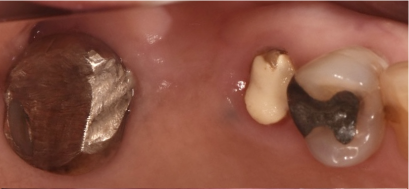上顎の奥歯にインプラント治療をする事で噛み合わせを回復した症例