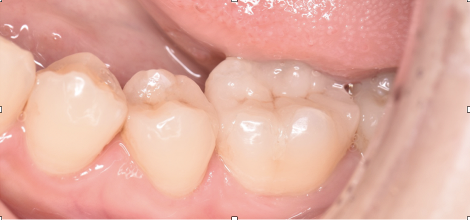 左下奥歯２本の銀歯をセラミックで治療した症例