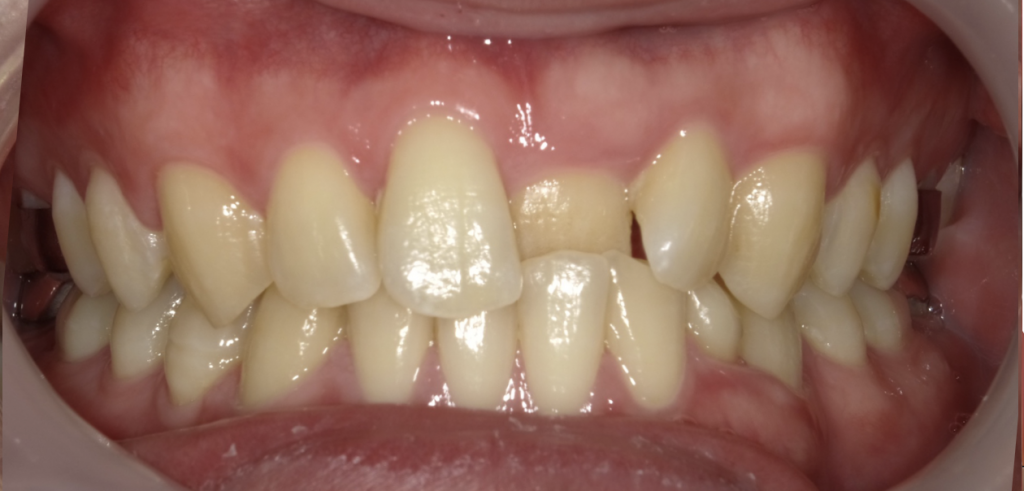 上顎の前歯の噛み合わせを矯正治療で改善した症例