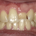 上顎の前歯の噛み合わせを矯正治療で改善した症例