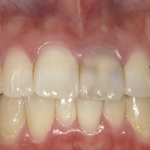 上顎の前歯１本をホワイトニングして審美改善した症例