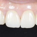 上の前歯の審美不良をオールセラミッククラウンで改善した症例　２