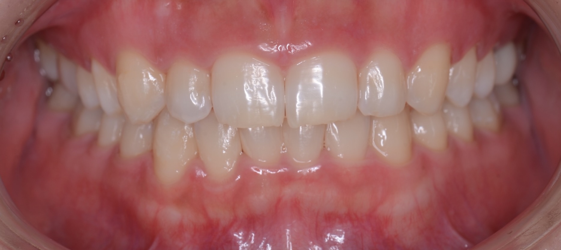 3ヶ月間のマウスピース矯正で歯並びを美しく改善した症例