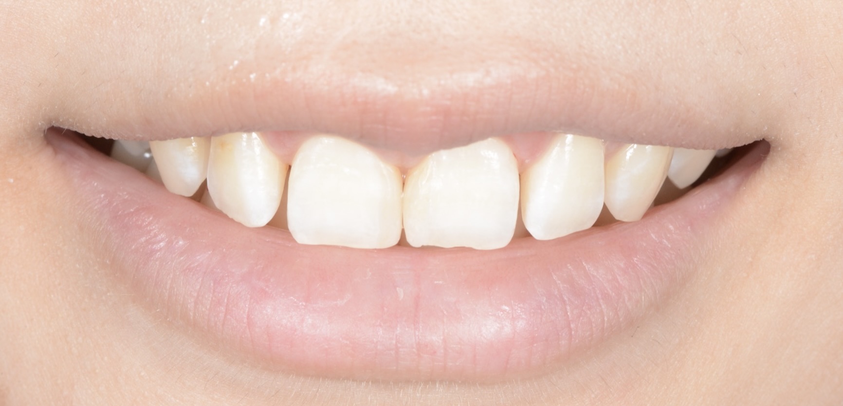 「ガミースマイル」と「すきっ歯」を改善した症例