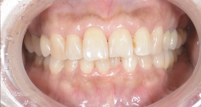繰り返す「歯のトラブル」インプラントを使って治療した症例