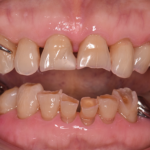 咬む力によって、ボロボロになってしまった前歯を改善した症例