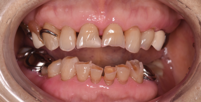 咬む力によって、ボロボロになってしまった前歯を改善した症例