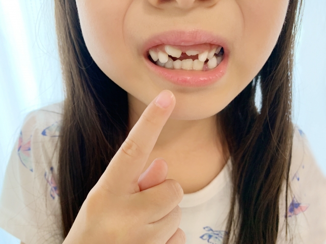 【池田市・石橋阪大前】子どもの矯正は痛い？保護者が知っておきたい不安と対処法｜桑田歯科