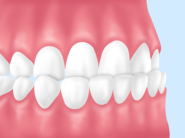 反対咬合（受け口）