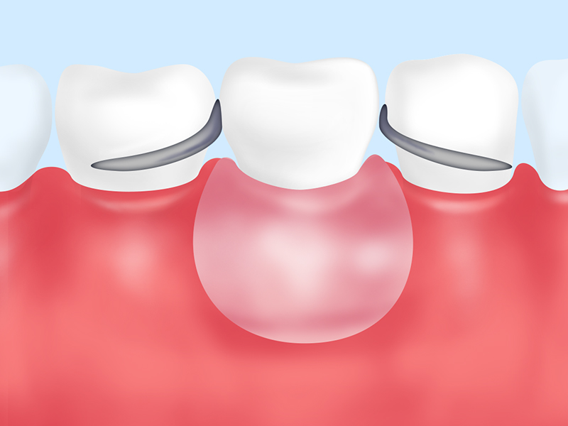 入れ歯とインプラントの比較