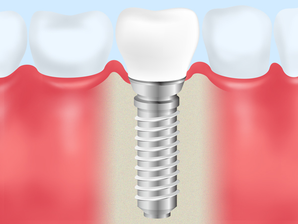 入れ歯とインプラントの比較