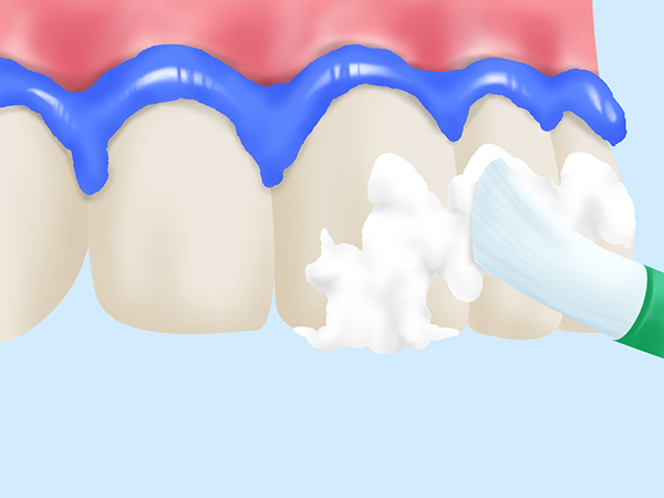 ホワイトニング効果が高く、短期間で歯を白くできる
