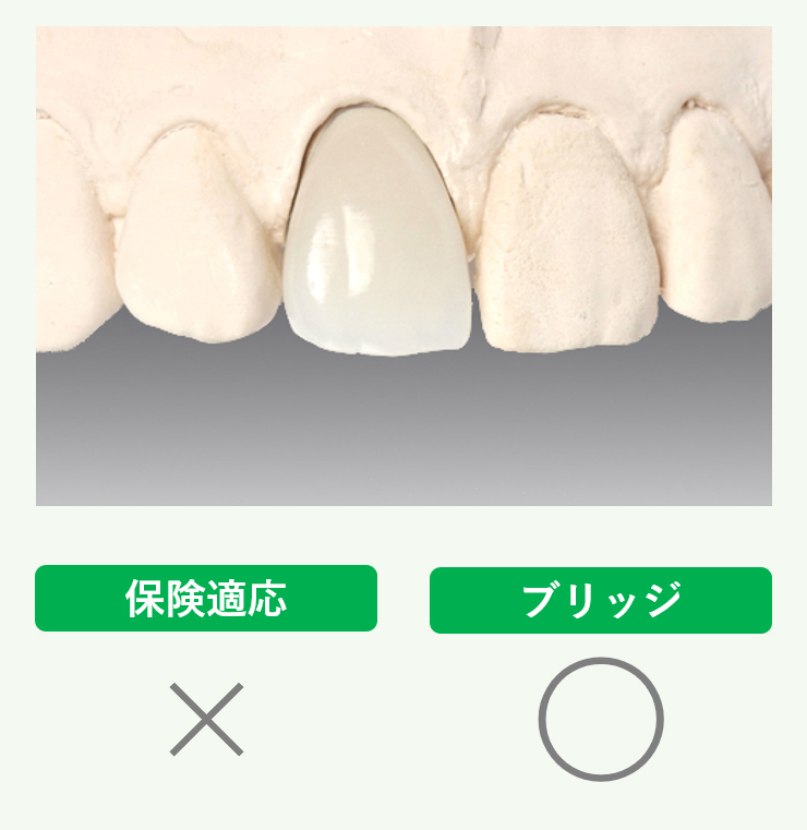 オールセラミッククラウン