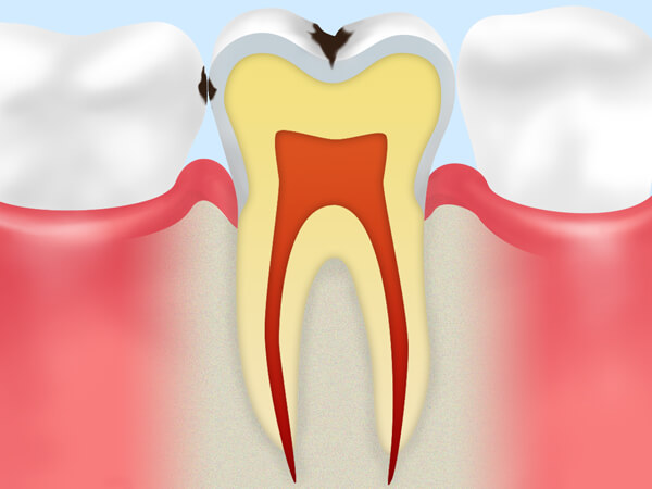 C1.エナメル質の虫歯