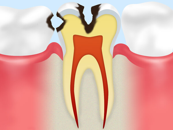C2.象牙質の虫歯