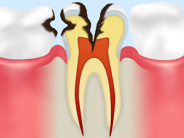 C3.神経にまで達した虫歯