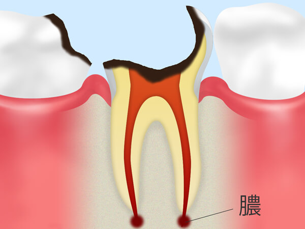 C4.歯の根っこまで達した虫歯