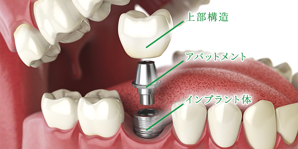 3つのパーツからなるインプラント