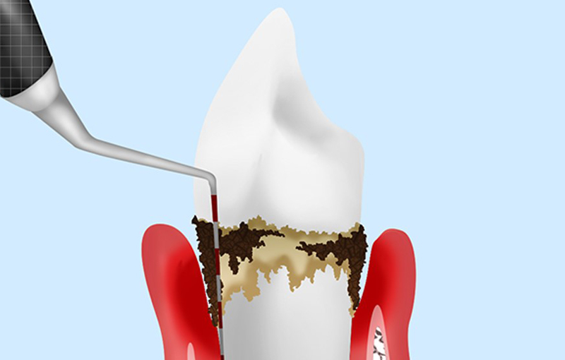 歯周病の検査