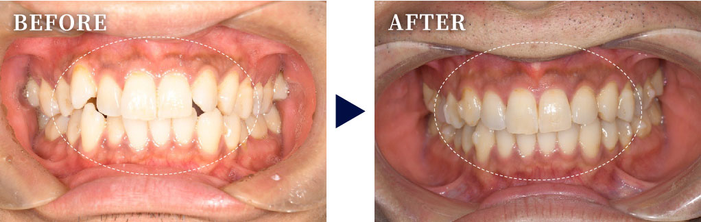 CASE.01　前歯の重なり（八重歯）