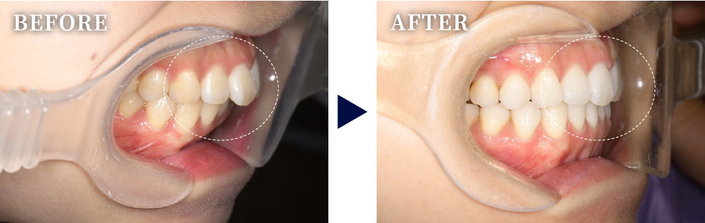 CASE.02　前歯の重なり（出っ歯）