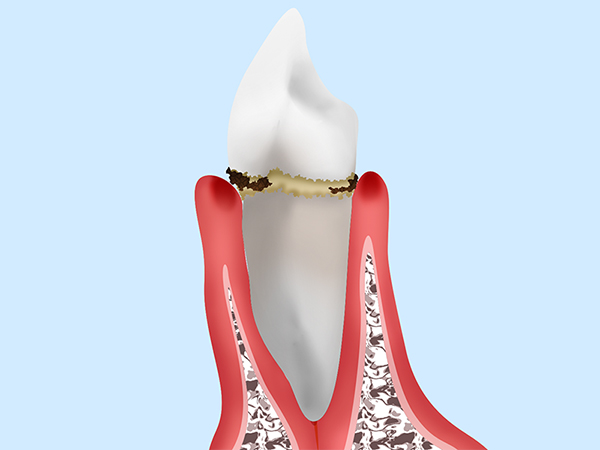 軽度の歯周病