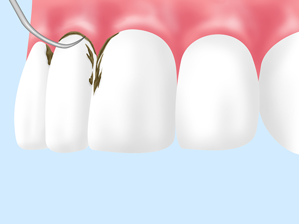 軽度の歯周病