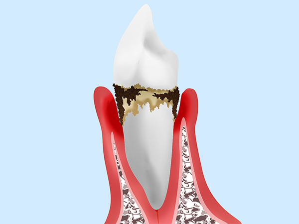 中等度の歯周病