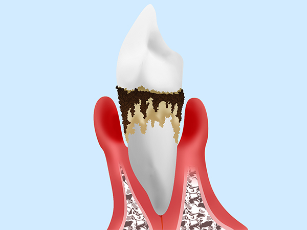 重度の歯周病