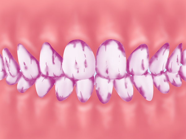 歯垢の染め出し検査